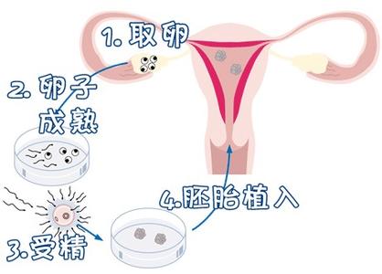 关于正规拉拉供卵代孕咨询
